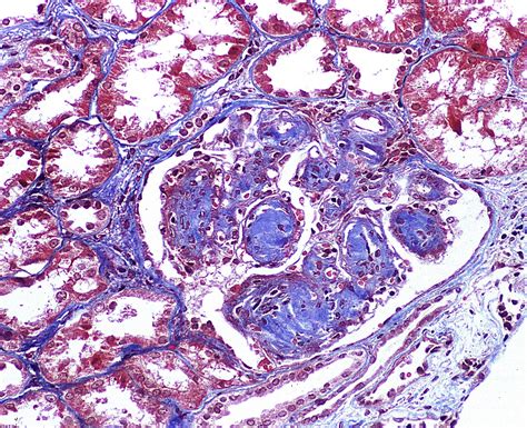 spike and dome appearance kidney|AJKD Atlas of Renal Pathology: Membranous .